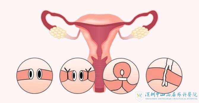 剖腹产