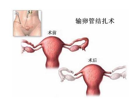 十几年前流产